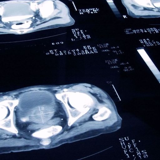 Why I'm urging other men to get checked for prostate cancer
 
Why I'm urging other men to get checked for prostate cancer