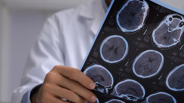 Amid Brett Favre’s Parkinson’s diagnosis, neurologist discusses how concussions impact risk Amid Brett Favre’s Parkinson’s diagnosis, neurologist discusses how concussions impact risk