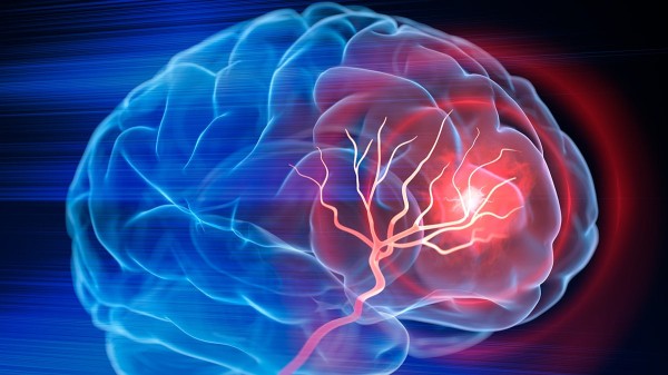 New stroke prevention guidelines released by American Stroke Association New stroke prevention guidelines released by American Stroke Association