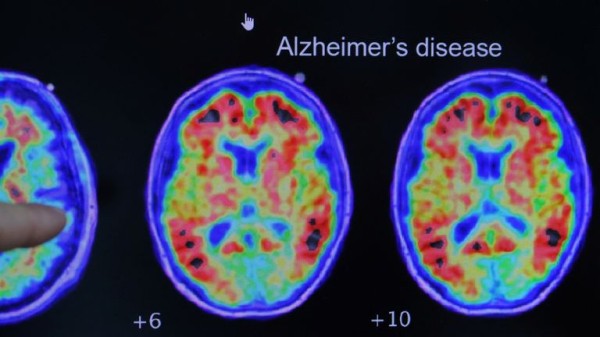 Pioneering Alzheimer's drug rejected for widespread use in NHS in England Pioneering Alzheimer's drug rejected for widespread use in NHS in England