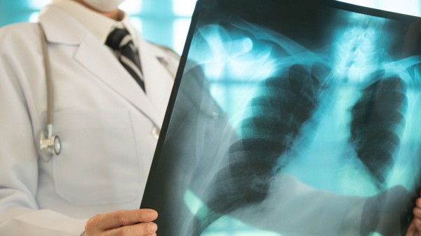 Tuberculosis has overtaken COVID as world's deadliest infectious disease