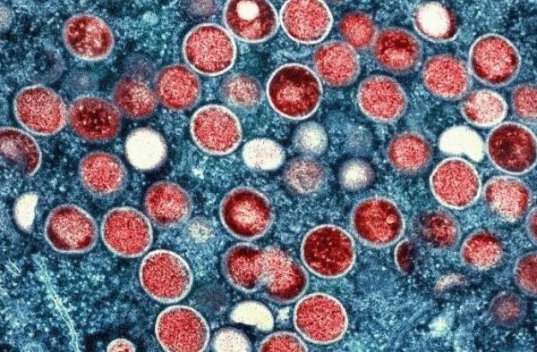 Additional case of new mpox strain detected in Britain for a total of four Additional case of new mpox strain detected in Britain for a total of four