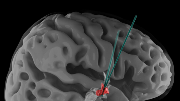 New brain therapy allows paralyzed patients to walk again: 'I feel my legs' New brain therapy allows paralyzed patients to walk again: 'I feel my legs'