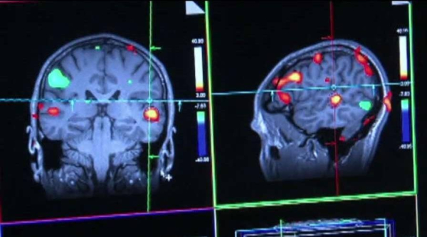 5 major Alzheimer’s discoveries scientists made in 2024