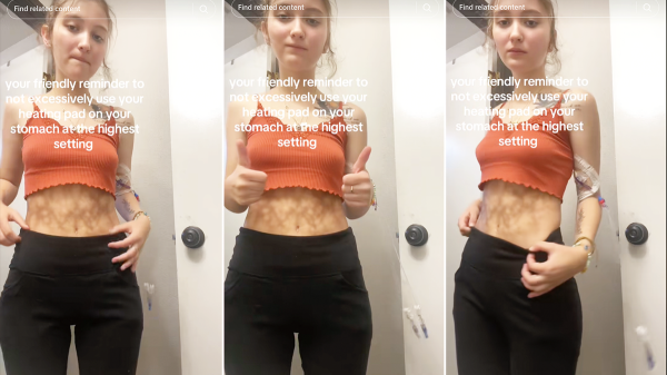 What is ‘toasted skin syndrome'? Heating pads and blankets can cause skin damage, experts warn What is ‘toasted skin syndrome'? Heating pads and blankets can cause skin damage, experts warn