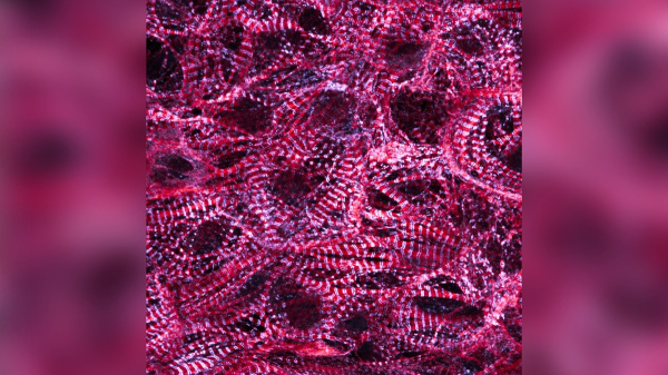 Stem cell therapy to correct heart failure in children could 'transform lives' Stem cell therapy to correct heart failure in children could 'transform lives'