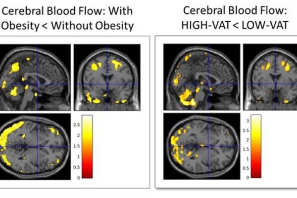 Deep belly fat could predict Alzheimer's disease decades ahead of symptoms Deep belly fat could predict Alzheimer's disease decades ahead of symptoms