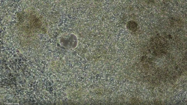 Stem cell therapy to correct heart failure in children could 'transform lives' Stem cell therapy to correct heart failure in children could 'transform lives'