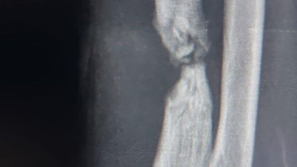 How the lives of the few child amputees allowed to leave Gaza are being rebuilt elsewhere How the lives of the few child amputees allowed to leave Gaza are being rebuilt elsewhere