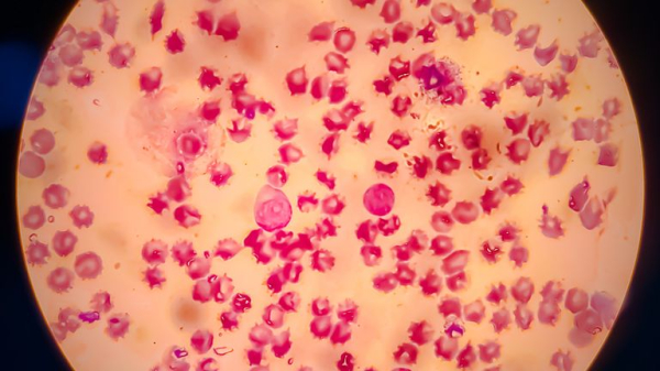 'Groundbreaking' sickle cell treatment to be offered to NHS patients for first time 'Groundbreaking' sickle cell treatment to be offered to NHS patients for first time