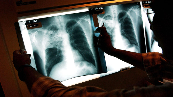 Kansas City tuberculosis outbreak is largest in US history Kansas City tuberculosis outbreak is largest in US history