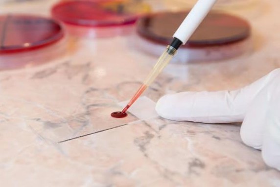 Rapid blood test can hasten treatment for stroke patients with brain bleeding Rapid blood test can hasten treatment for stroke patients with brain bleeding
