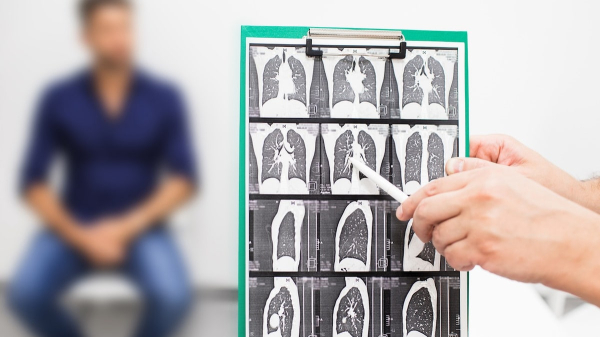 Lingering lung disorders 5 years post-COVID: Here's what to know