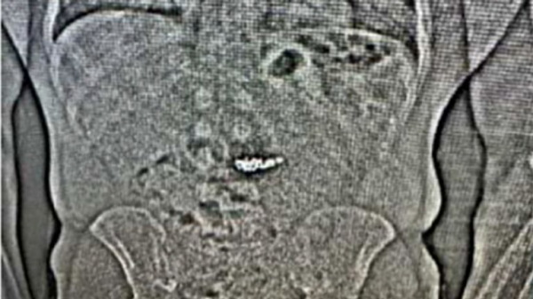 Diamond Tiffany earrings swallowed by suspected thief are recovered by Florida police