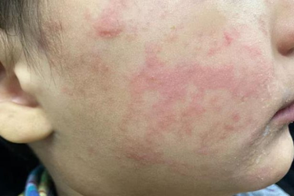 Measles cases in western Texas rise to 146, possibly spreading to other areas Measles cases in western Texas rise to 146, possibly spreading to other areas