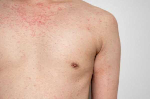 Multistate measles outbreak leads to dangerous vitamin A toxicity