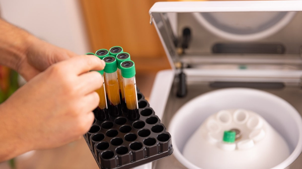 Stem-cell therapy for Parkinson's shows 'strong promise' in relieving symptoms Stem-cell therapy for Parkinson's shows 'strong promise' in relieving symptoms