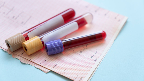 Blood test could predict skin cancer recurrence, study shows Blood test could predict skin cancer recurrence, study shows