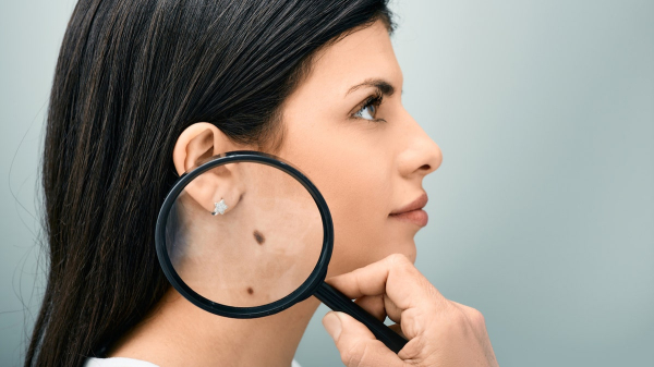 Blood test could predict skin cancer recurrence, study shows Blood test could predict skin cancer recurrence, study shows