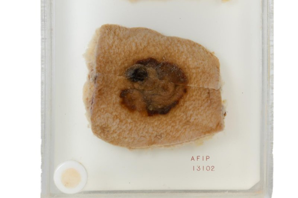 Blood test to predict tumor recurrence in advanced skin cancer called highly accurate Blood test to predict tumor recurrence in advanced skin cancer called highly accurate