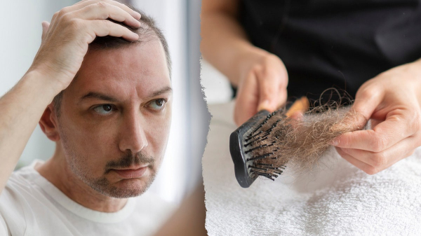Ozempic, other semaglutides linked to hair loss: Here's what to know