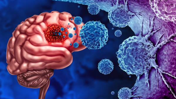 Brain cancer patients who received this pain medication lived longer, study shows