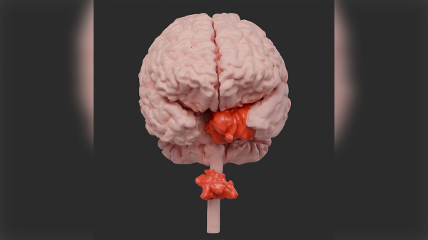 Rare spinal cancer tumor removed through patient’s eye at university hospital