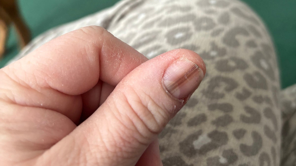 Mom credits TikTok video for cancer diagnosis after spotting strange nail marking