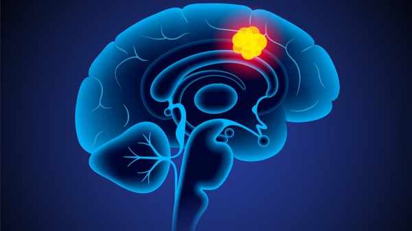 Brain cancer patients who received this pain medication lived longer, study shows