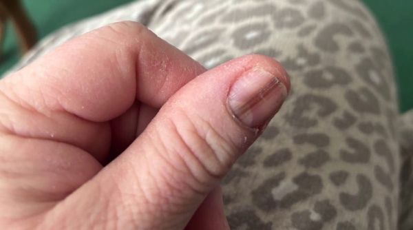 Mom credits TikTok video for cancer diagnosis after spotting strange nail marking