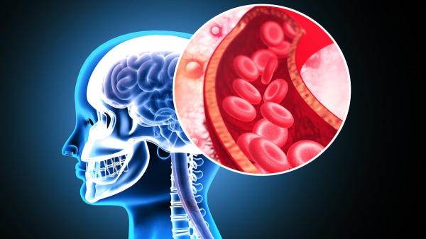 Stanford researchers develop ‘game-changing’ stroke treatment that doubles effectiveness Stanford researchers develop ‘game-changing’ stroke treatment that doubles effectiveness