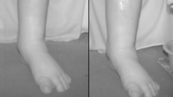 AI foot scanner recognises warning signs of heart failure to keep people out of hospital, researchers say AI foot scanner recognises warning signs of heart failure to keep people out of hospital, researchers say