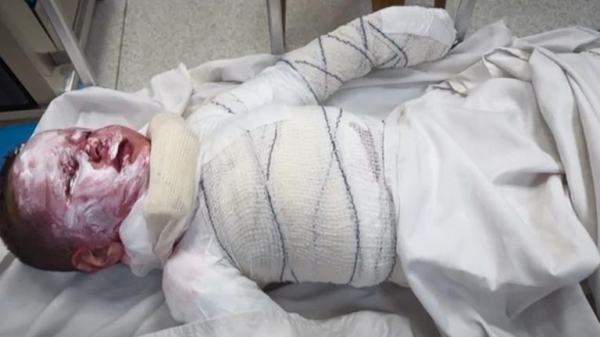 Amputations, badly burned bomb victims and lack of medicine: British surgeons on life in Gaza