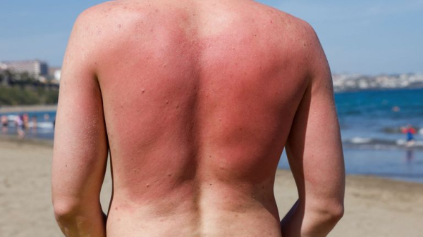 Sunburn isn't just red skin - here's what's happening underneath the burn Sunburn isn't just red skin - here's what's happening underneath the burn