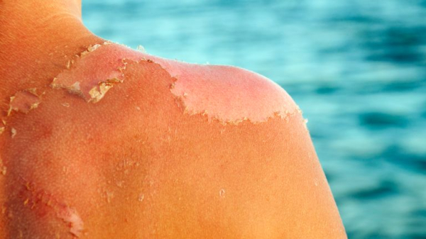 Sunburn isn't just red skin - here's what's happening underneath the burn Sunburn isn't just red skin - here's what's happening underneath the burn