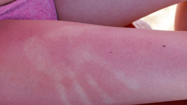 Sunburn isn't just red skin - here's what's happening underneath the burn Sunburn isn't just red skin - here's what's happening underneath the burn