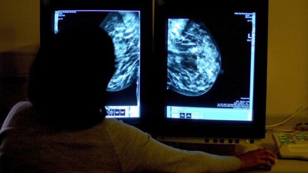 'Transformational' new drug could stop breast cancer tumours before they grow, trial finds 'Transformational' new drug could stop breast cancer tumours before they grow, trial finds