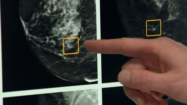 'Transformational' new drug could stop breast cancer tumours before they grow, trial finds 'Transformational' new drug could stop breast cancer tumours before they grow, trial finds