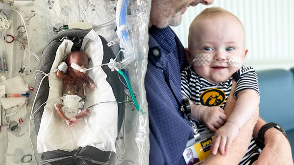 World's most premature baby defies all medical odds to reach 1st birthday World's most premature baby defies all medical odds to reach 1st birthday