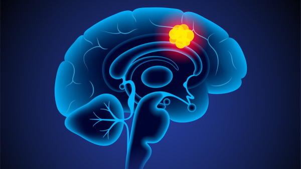 Man's deadly brain cancer tumor disappears after experimental drug trial Man's deadly brain cancer tumor disappears after experimental drug trial