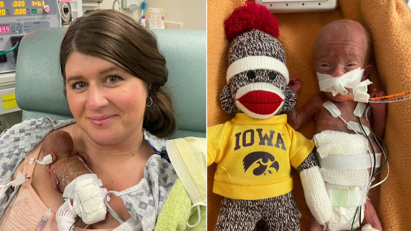 World's most premature baby defies all medical odds to reach 1st birthday World's most premature baby defies all medical odds to reach 1st birthday