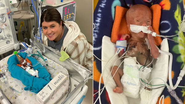World's most premature baby defies all medical odds to reach 1st birthday World's most premature baby defies all medical odds to reach 1st birthday