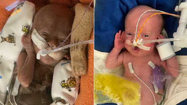 World's most premature baby defies all medical odds to reach 1st birthday World's most premature baby defies all medical odds to reach 1st birthday