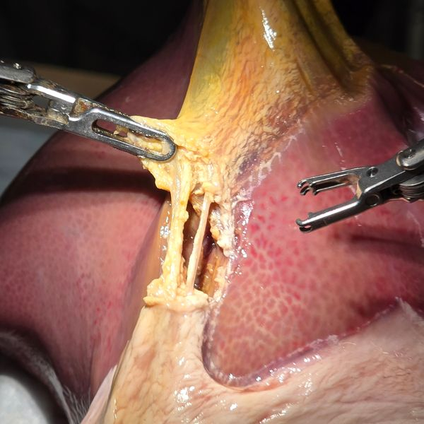 Robot performs realistic gallbladder surgery 'with 100% accuracy'