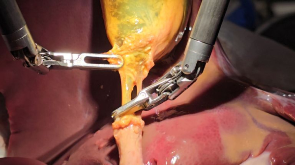 Robot performs realistic gallbladder surgery 'with 100% accuracy'