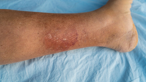 More cases of deadly ‘flesh-eating’ bacterial infection in popular vacation destination More cases of deadly ‘flesh-eating’ bacterial infection in popular vacation destination