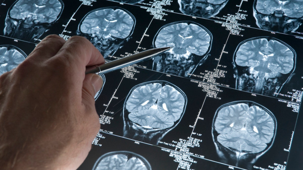 Alzheimer’s researchers say targeting brain sugar could help protect against dementia