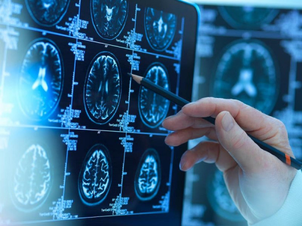 Researchers: Small traces of lithium may help prevent Alzheimer's Researchers: Small traces of lithium may help prevent Alzheimer's