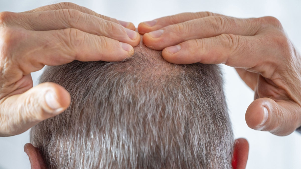 Hair-loss drug tied to suicides, depression and anxiety in global study