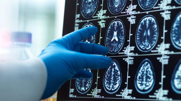 New vitamin compound shows promise for reversing Alzheimer's damage to the brain New vitamin compound shows promise for reversing Alzheimer's damage to the brain